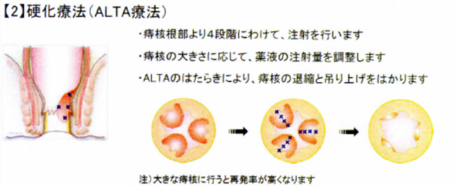 硬化療法のイメージ図