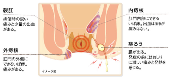 痔のイメージ図