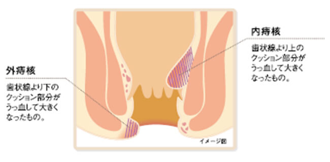 痔核のイメージ図