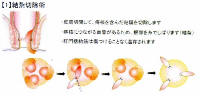 結紮切除術のイメージ図