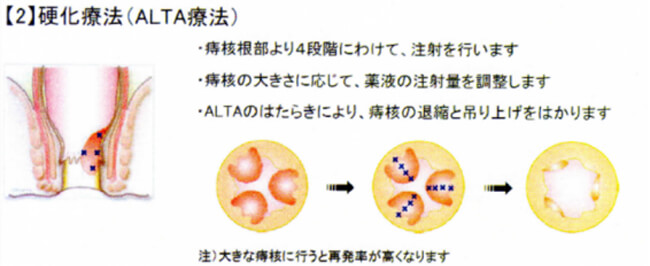 硬化療法のイメージ図