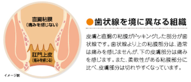 外痔核のイメージ図