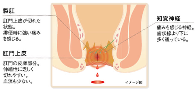 裂肛のイメージ図