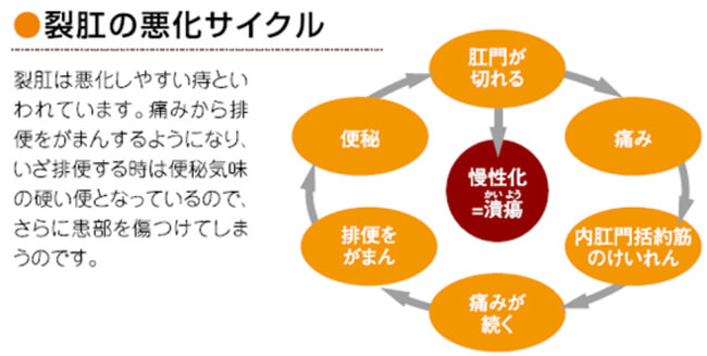 裂肛の悪化サイクルのイメージ図