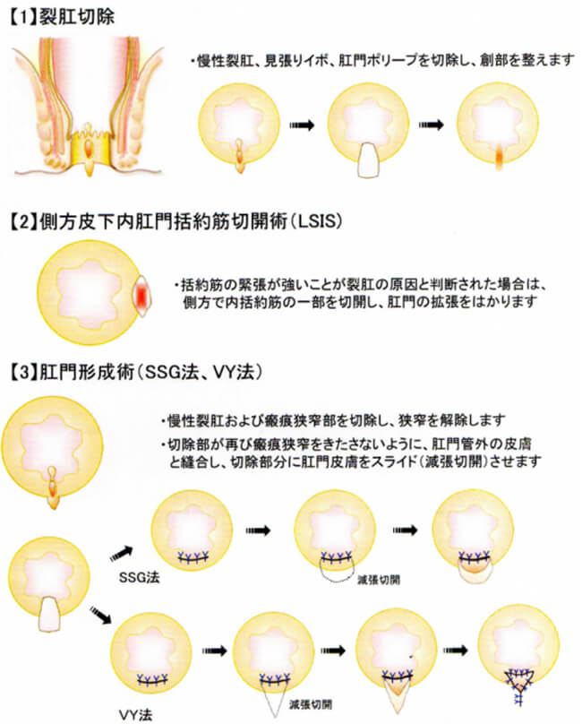 裂肛切除のイメージ図