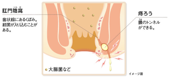 痔ろうのイメージ図