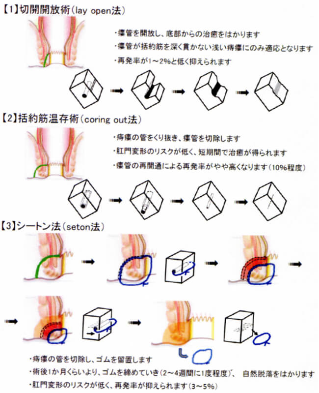 痔瘻の手術のイメージ図