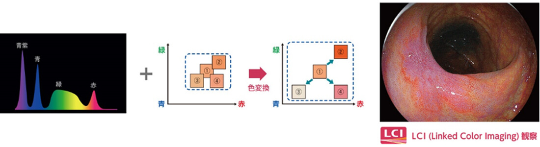 LCI（Linked Color Imaging）観察