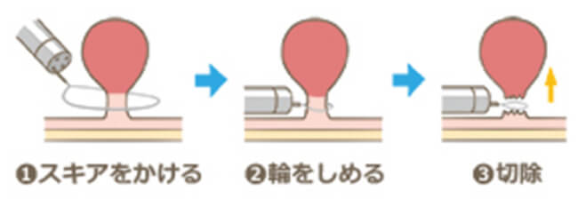 コールドポリペクトミーのイメージ図