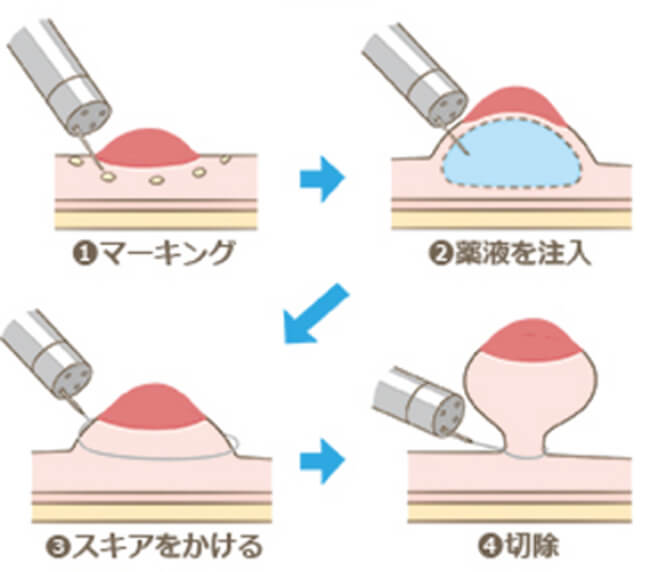 内視鏡的粘膜切除術のイメージ図